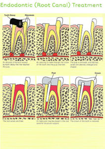 root-canal-scan